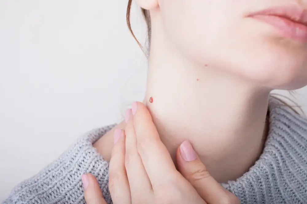 Close-up of a neck with a mole before mole removal.