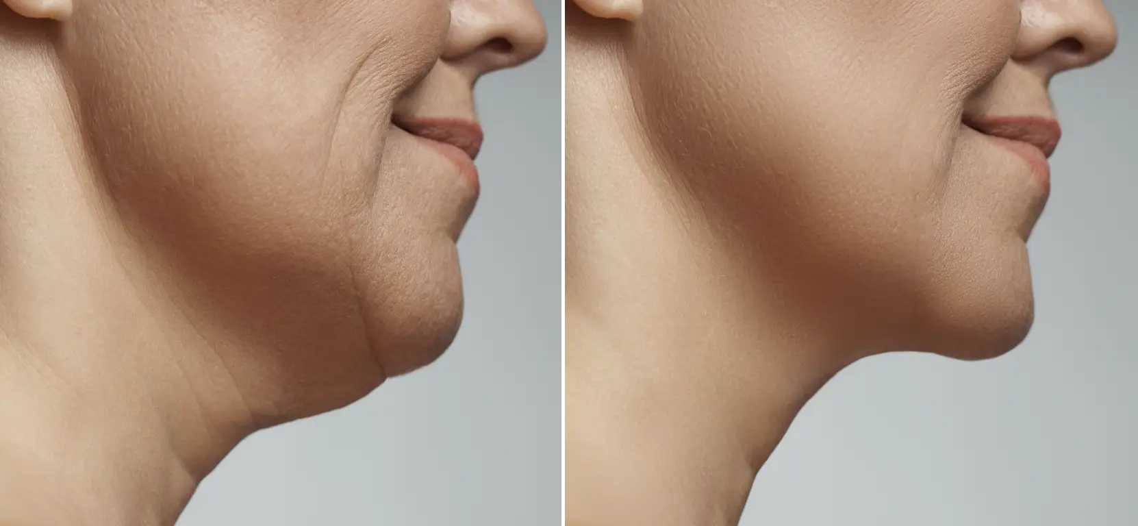 Side-by-side comparison showing differences in chin and neck contour