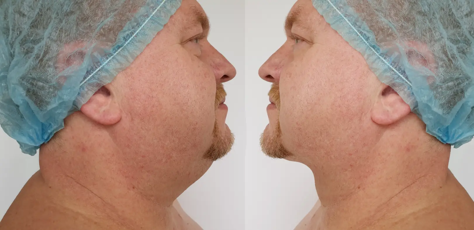 Side-by-side male profile comparison showing cheek and jawline contour differences