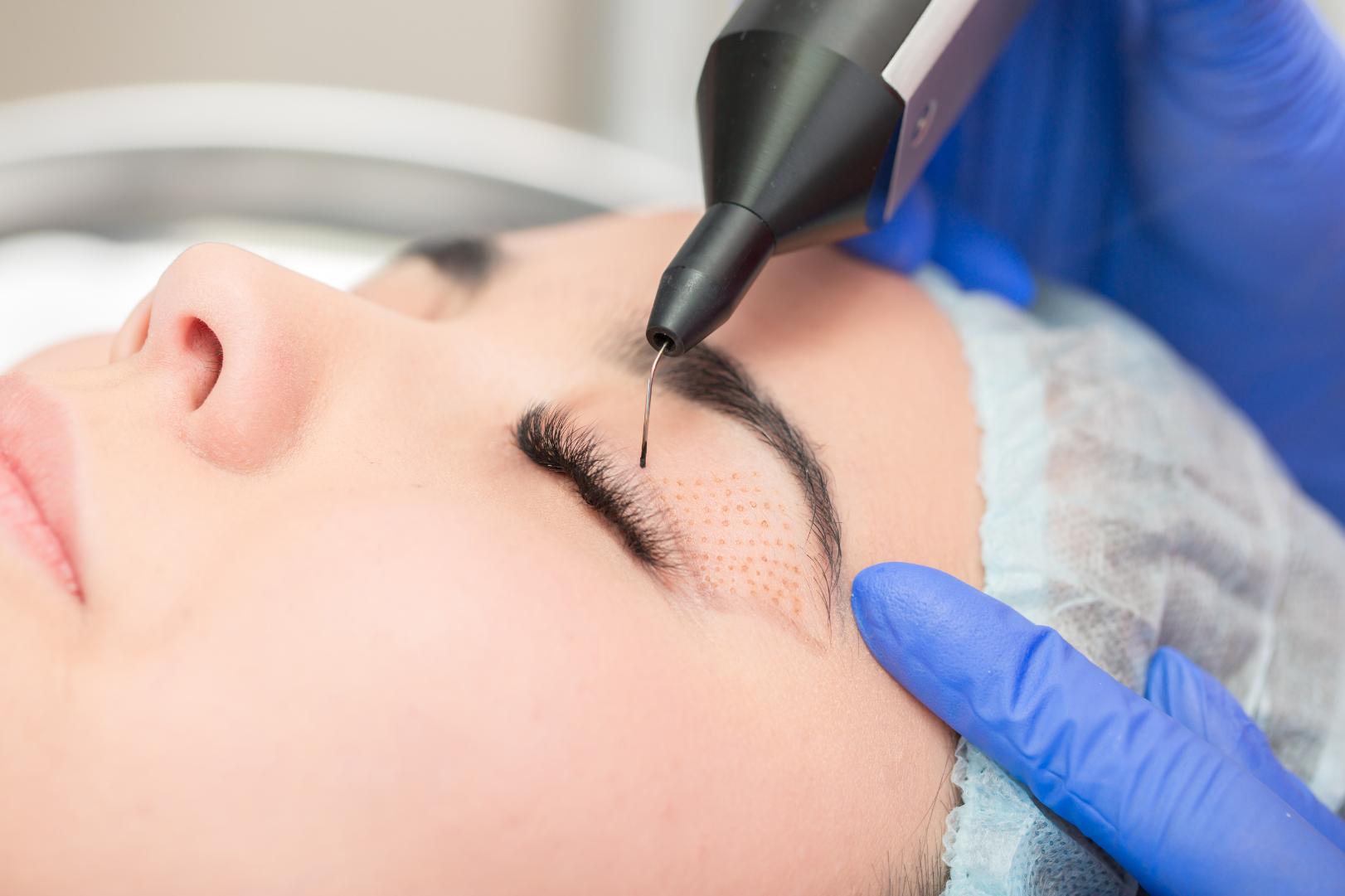 Practitioner using a surgical device near a patient's upper eyelid during an eyelid procedure.