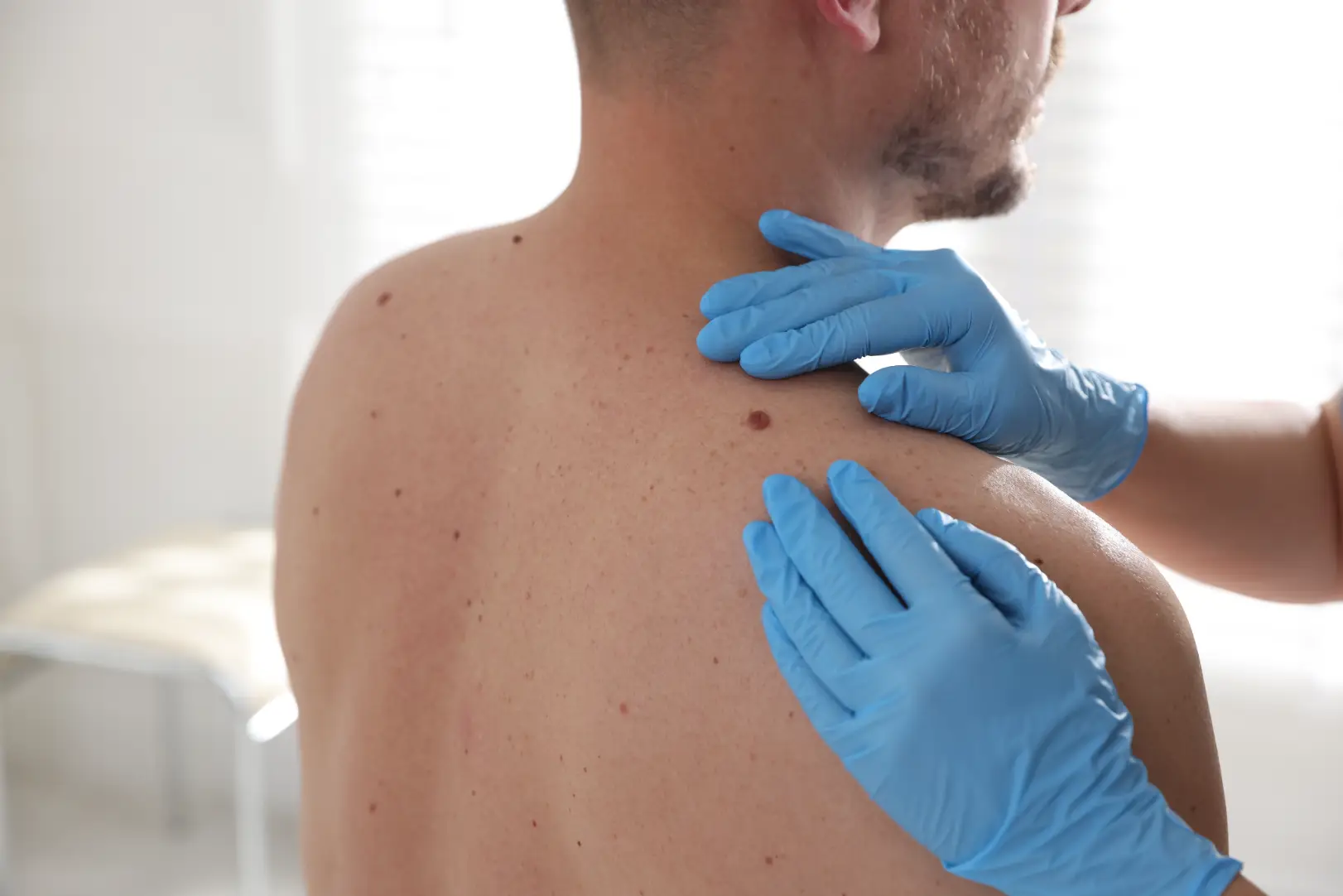 Blue-gloved hands examine a man's upper back and shoulder where several brown skin spots are visible.